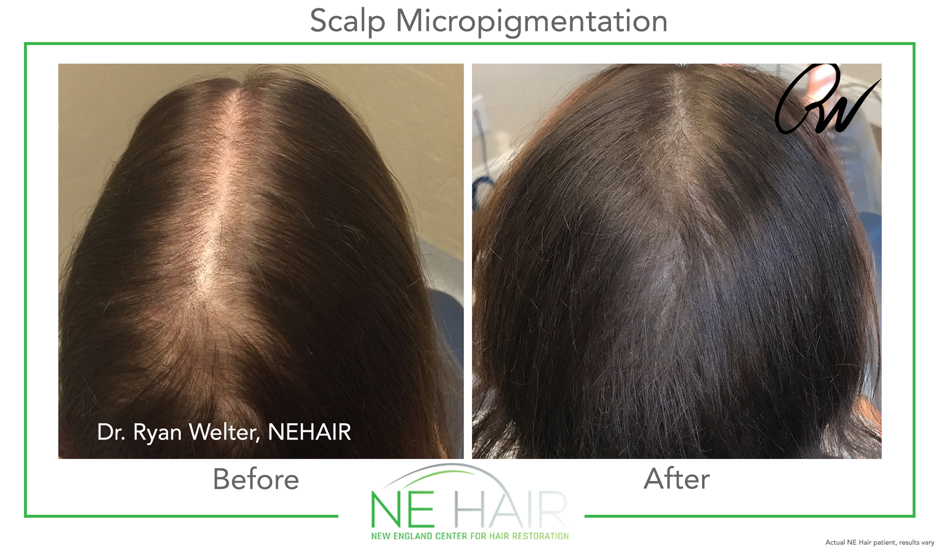 Scalp Micropigmentation Before and After Pictures Boston, MA